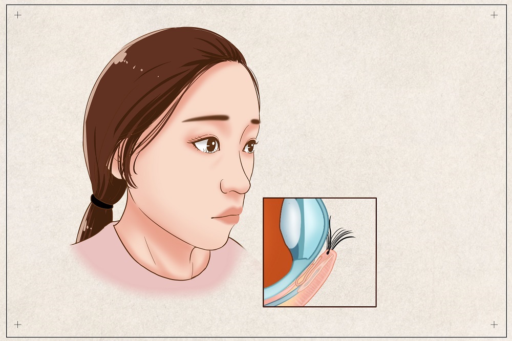 倒睫會自己好嗎？