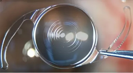 白內(nèi)障多焦點人工晶體