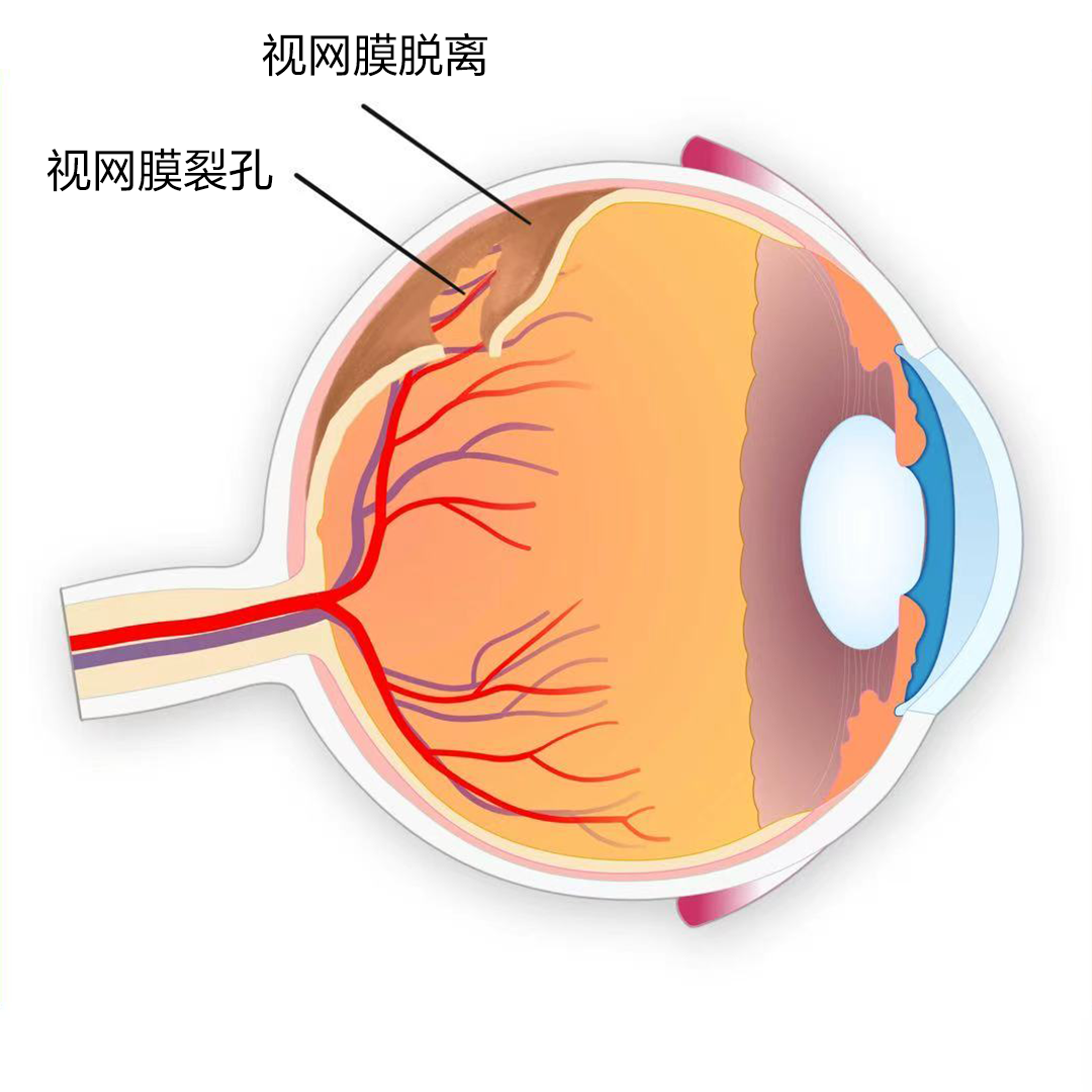 視網膜脫離