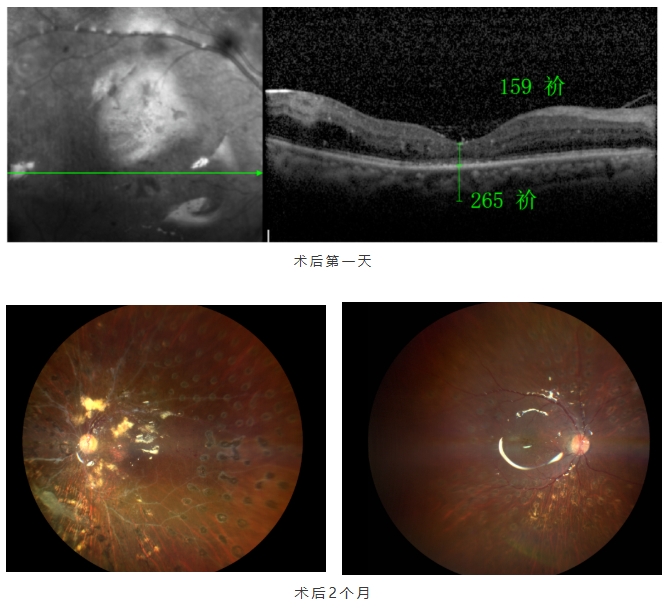 糖尿病視網(wǎng)膜病變